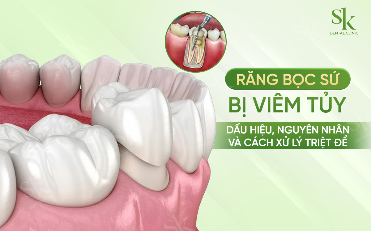 Răng bọc sứ bị viêm tuỷ