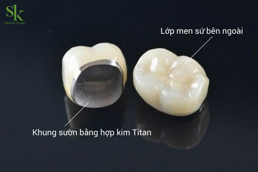 Răng sứ kim loại