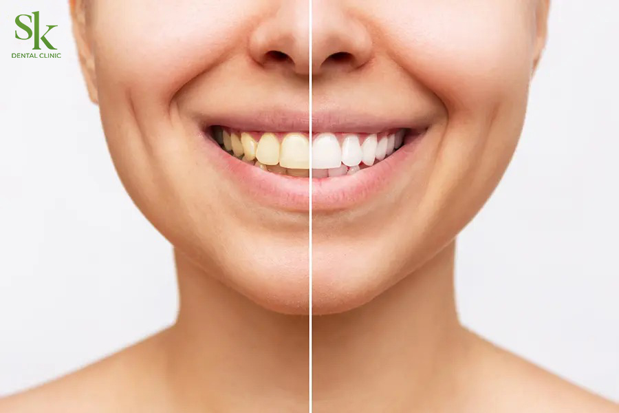 Sự khác biệt của bọc răng sứ