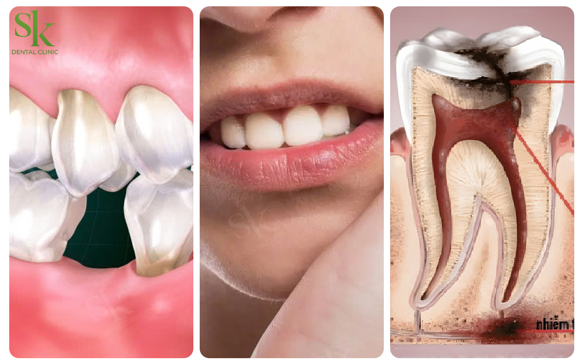 Hậu quả bọc răng sứ bị viêm tủy