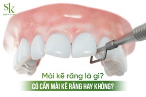 Mài kẽ răng