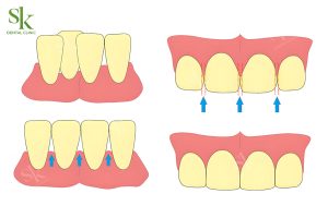 Mài kẽ răng có ảnh hưởng đến tủy răng?