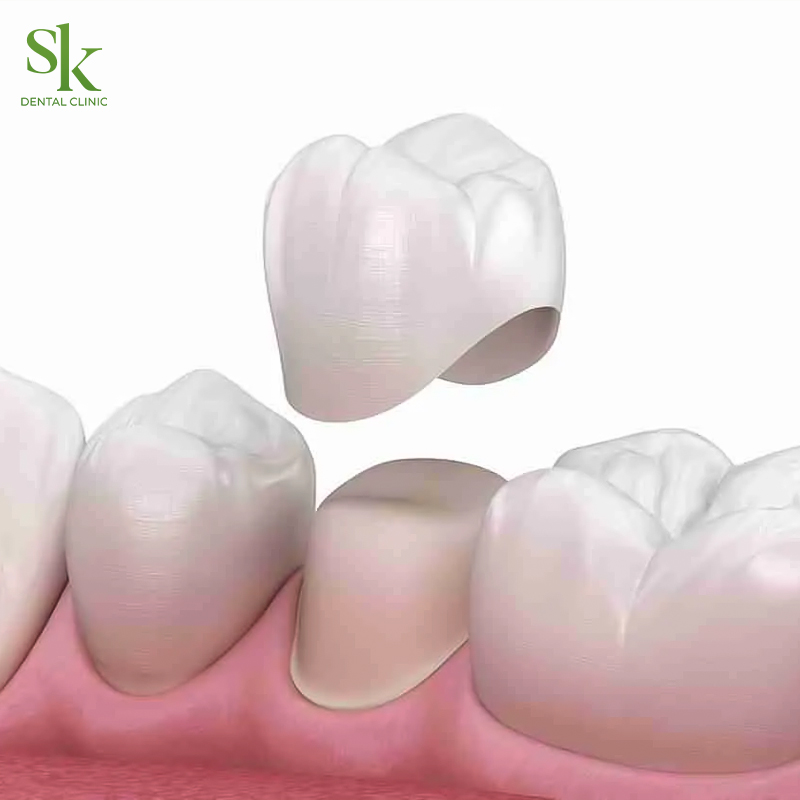 Cấu tạo của mão răng sứ