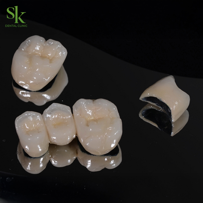 Bọc mão sứ giá bao nhiêu?
