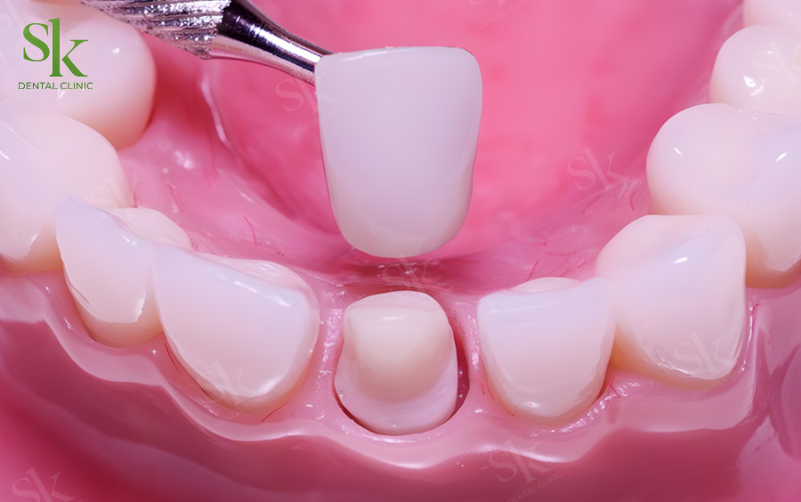 Răng khi bọc sứ