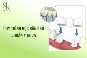 Quy trình bọc răng sứ chuẩn y khoa