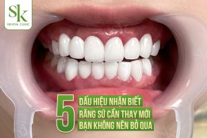 Dấu hiệu nhận biết răng sứ cần thay mới