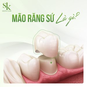 Mão răng sứ là gì?
