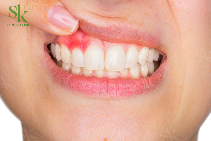 Ê buốt, đau nhức kéo dài quanh răng sứ