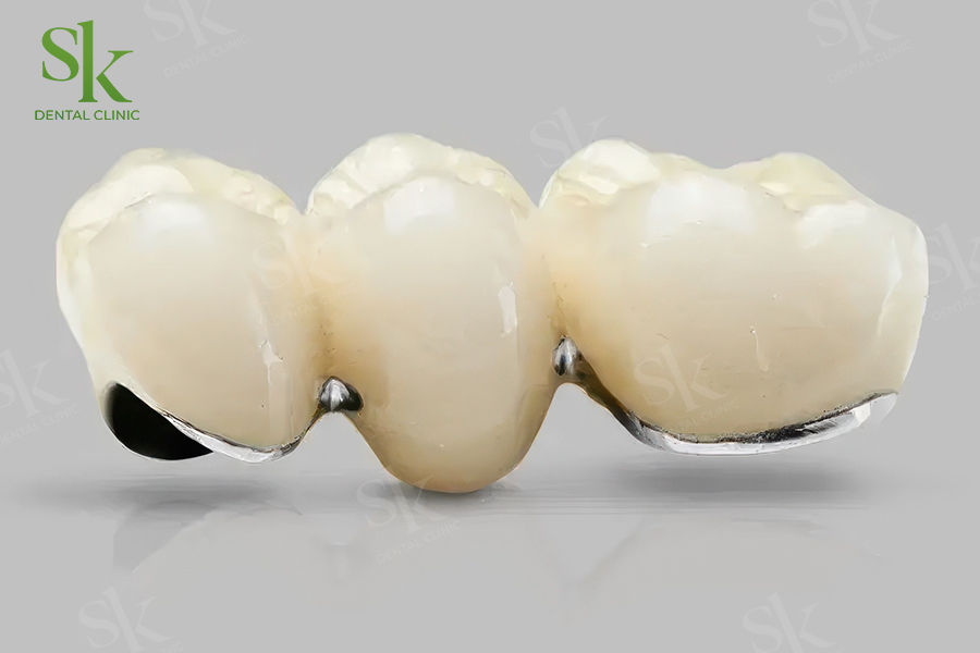 Răng sứ kim loại
