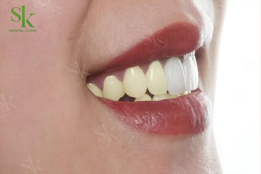 Răng sứ bị ố vàng, đổi màu hoặc nứt mẻ