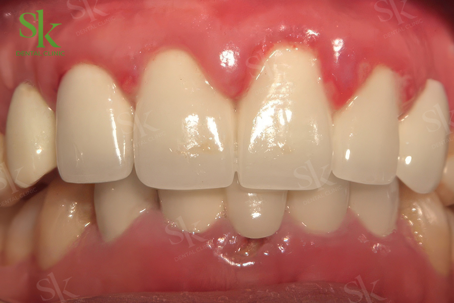 Viền nướu quanh răng sứ bị đen hoặc viêm đỏ