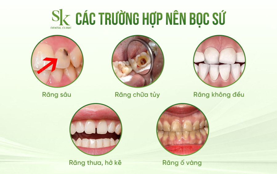 trường hợp nên bọc sứ