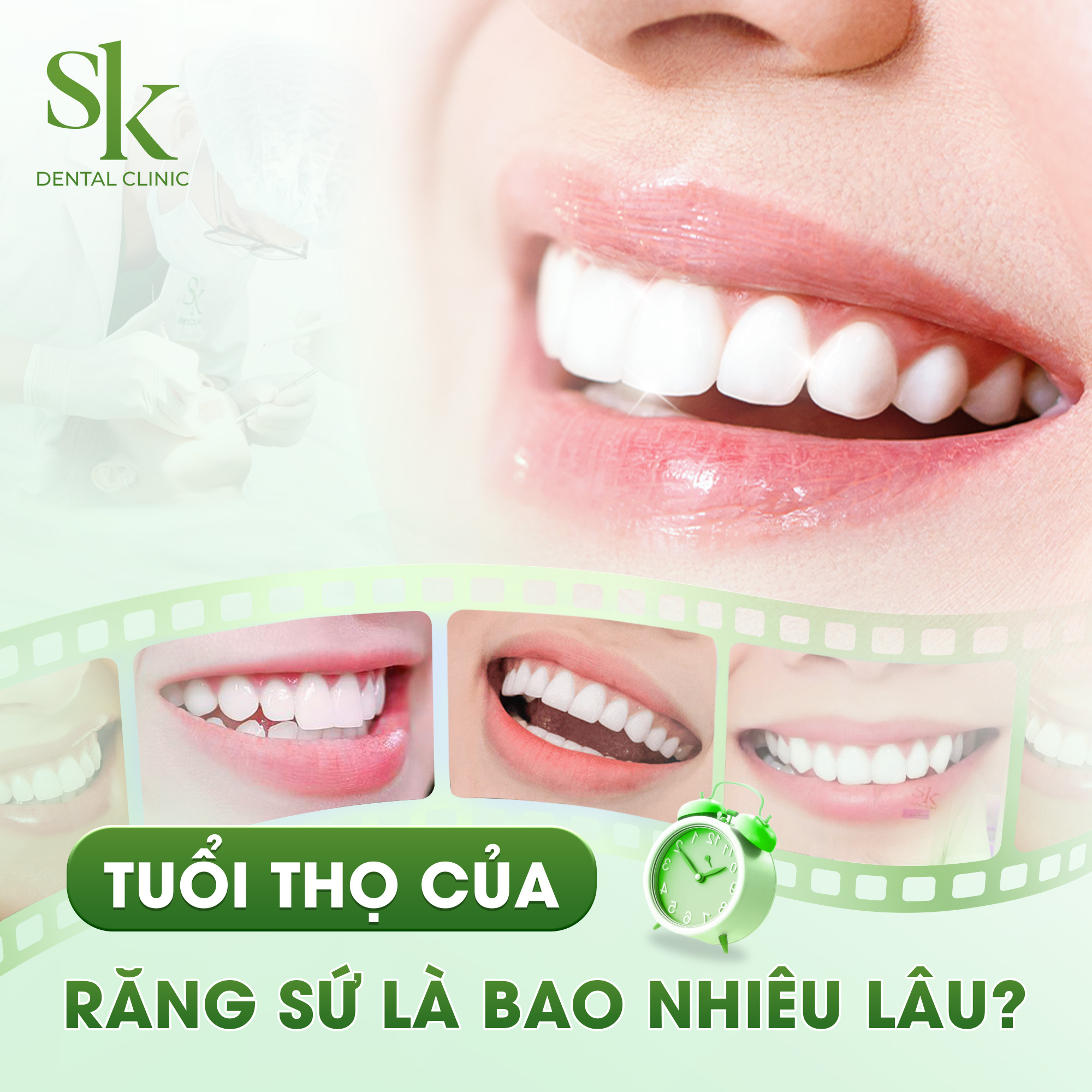 Tuổi thọ răng sứ bao lâu?