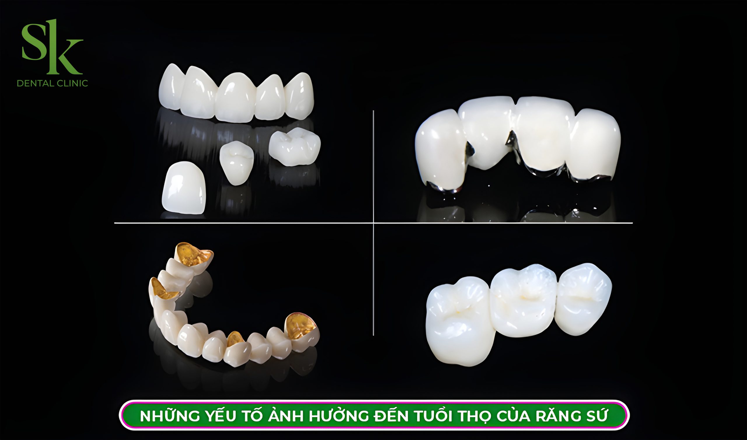 Những Yếu Tố Ảnh Hưởng Đến Tuổi Thọ Răng Sứ