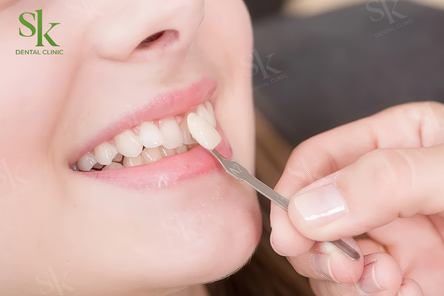 Khi nào cần thay mới răng sứ