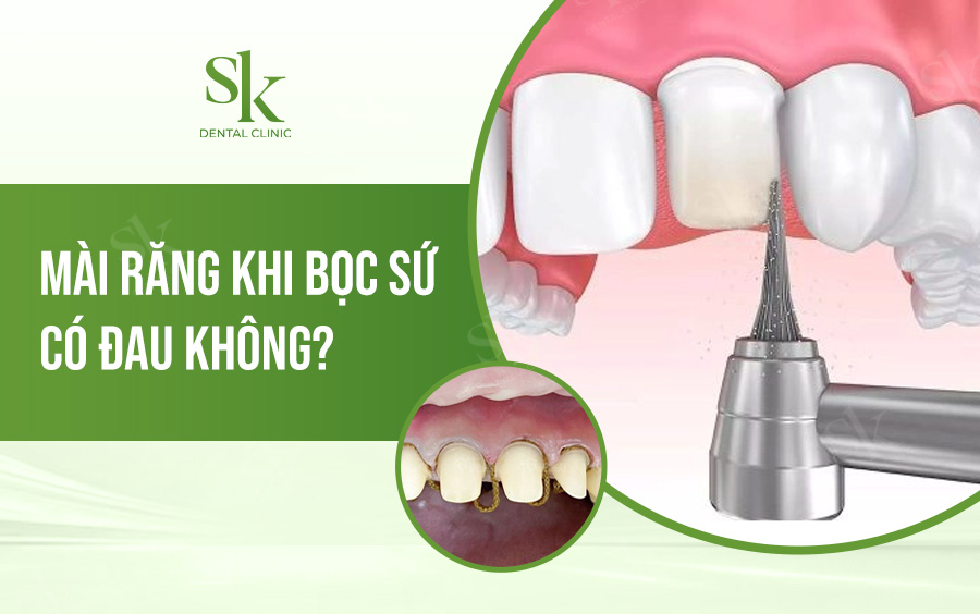 Mài răng khi bọc sứ có đau không?