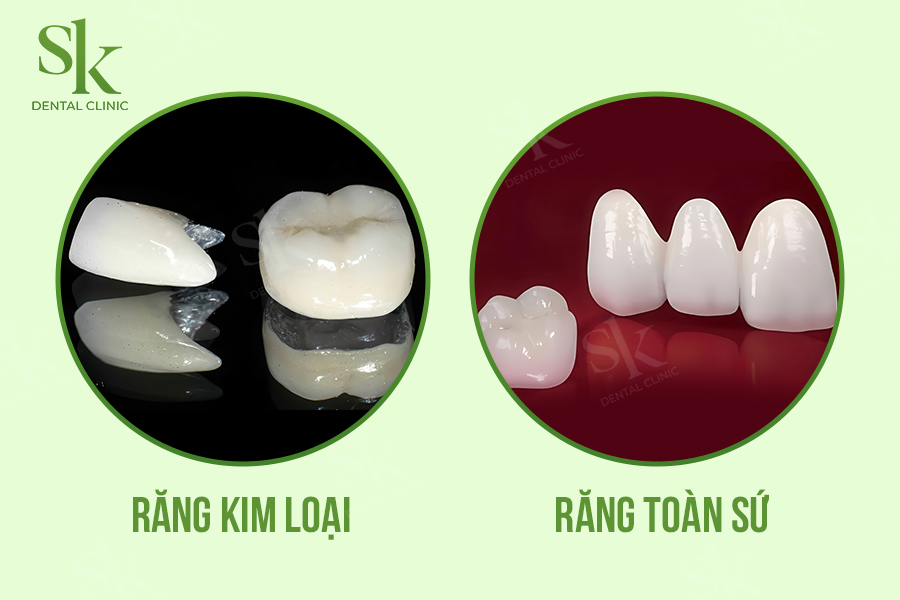bọc răng sứ kim loại và toàn sứ