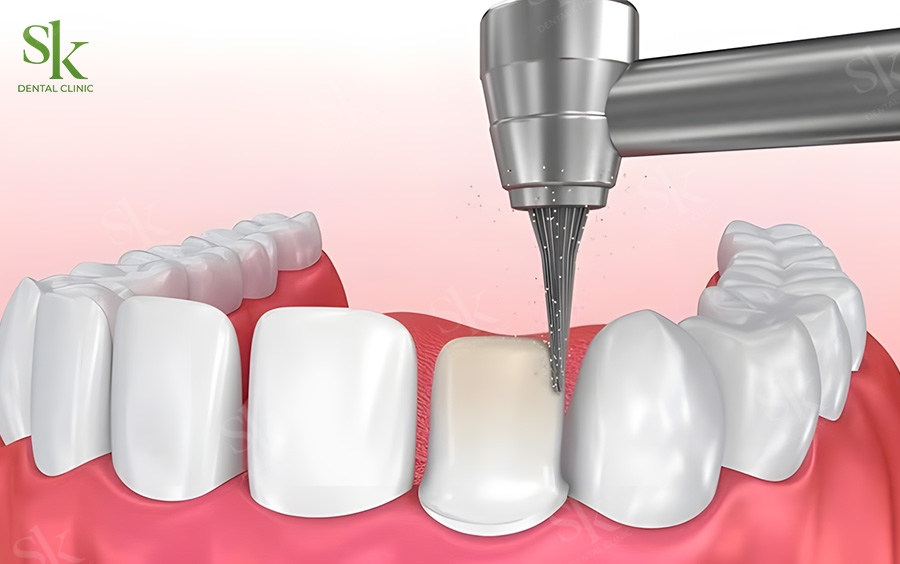 Mài răng bọc sứ