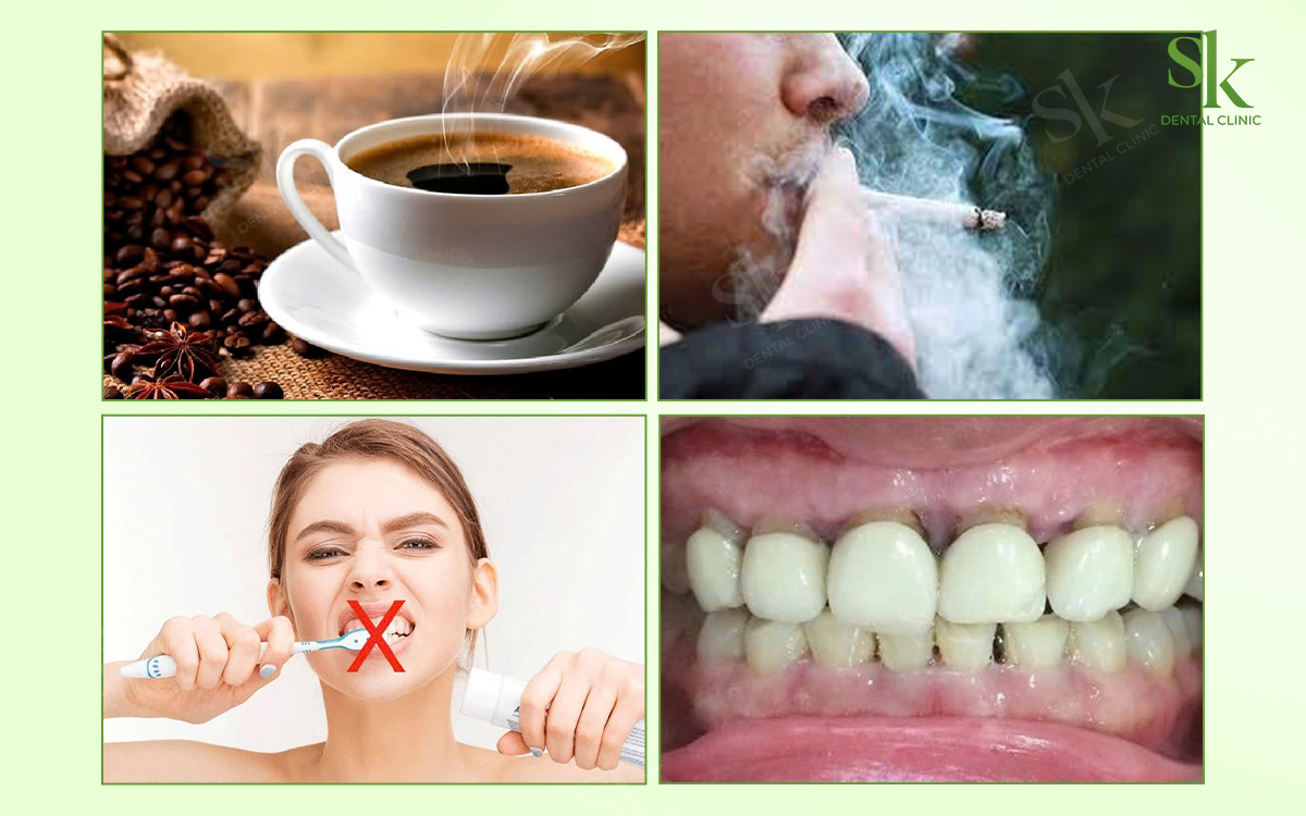 Nguyên nhân làm răng sứ ố vàng, xỉn màu