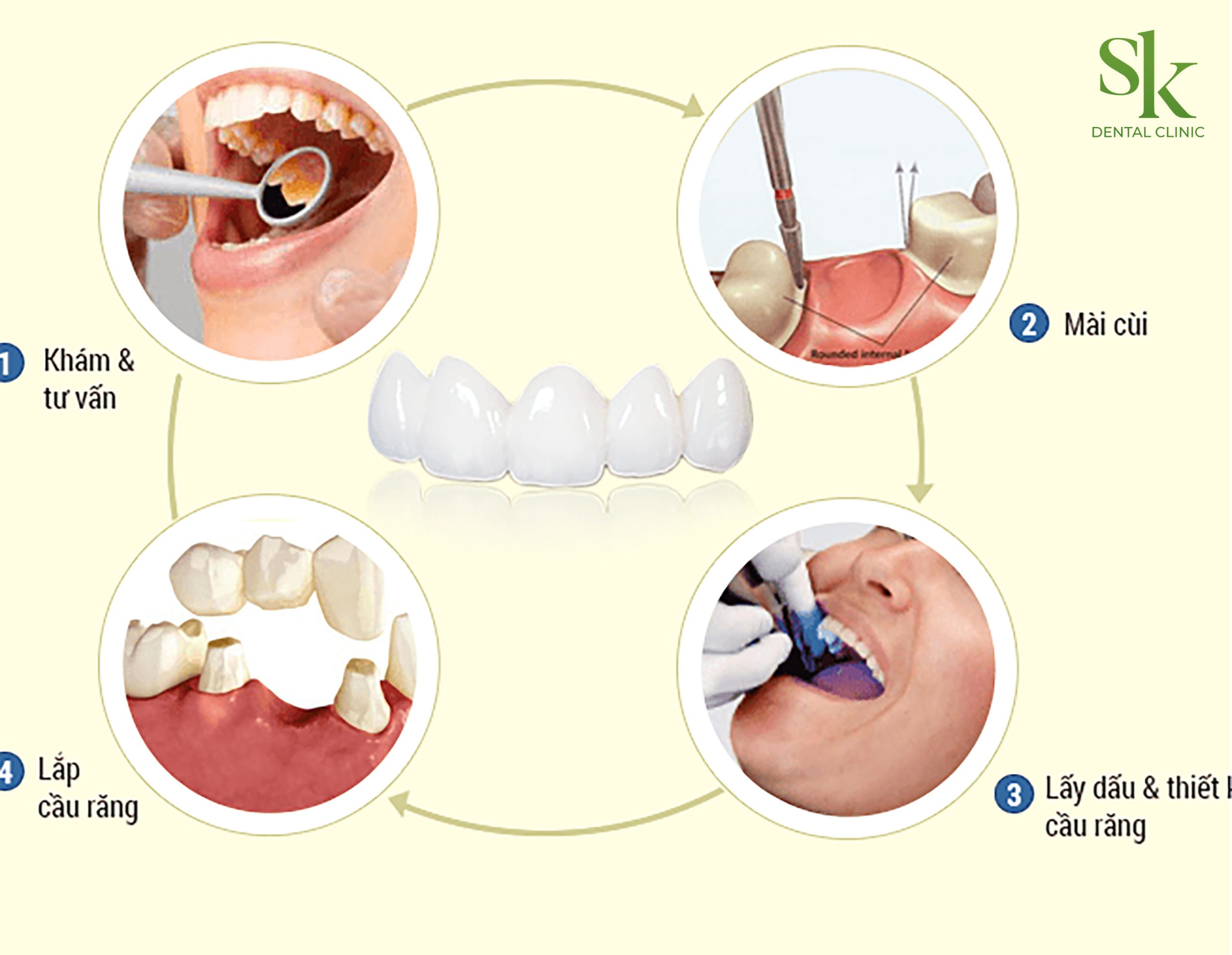 Quy Trình Bọc Răng Sứ Khi Về Già