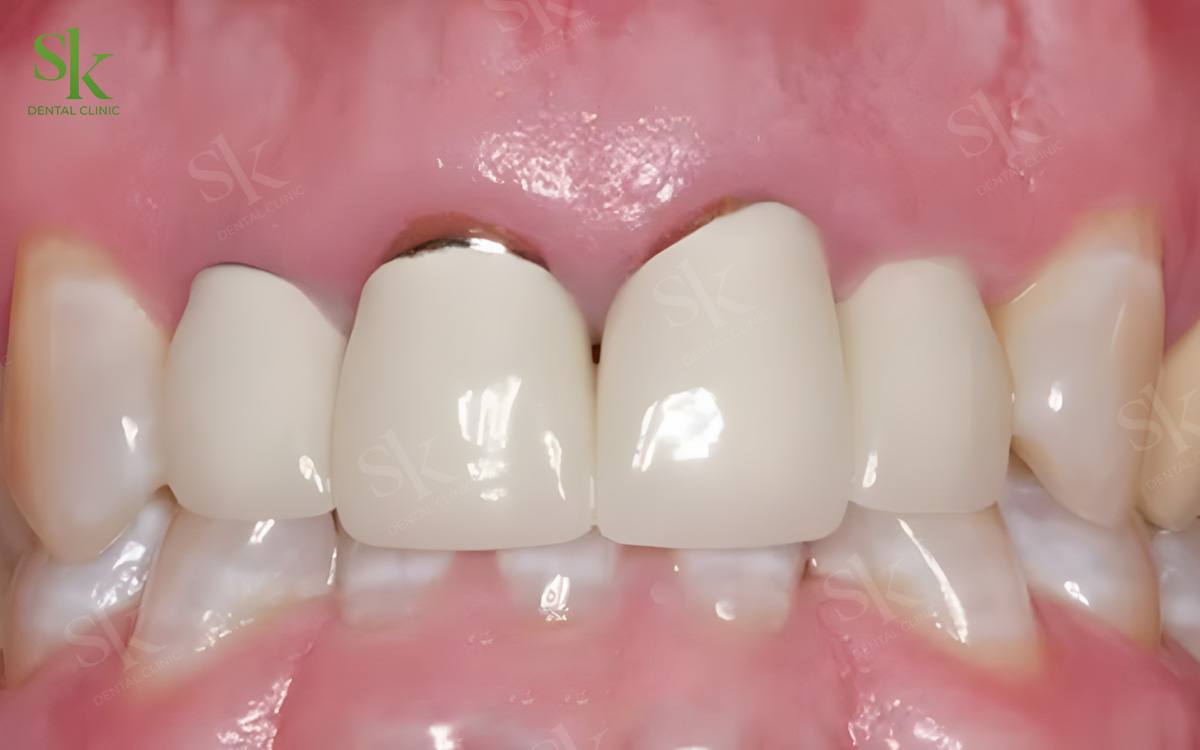 Răng bọc sứ không chăm đúng cách gây ra nhiều vấn đề