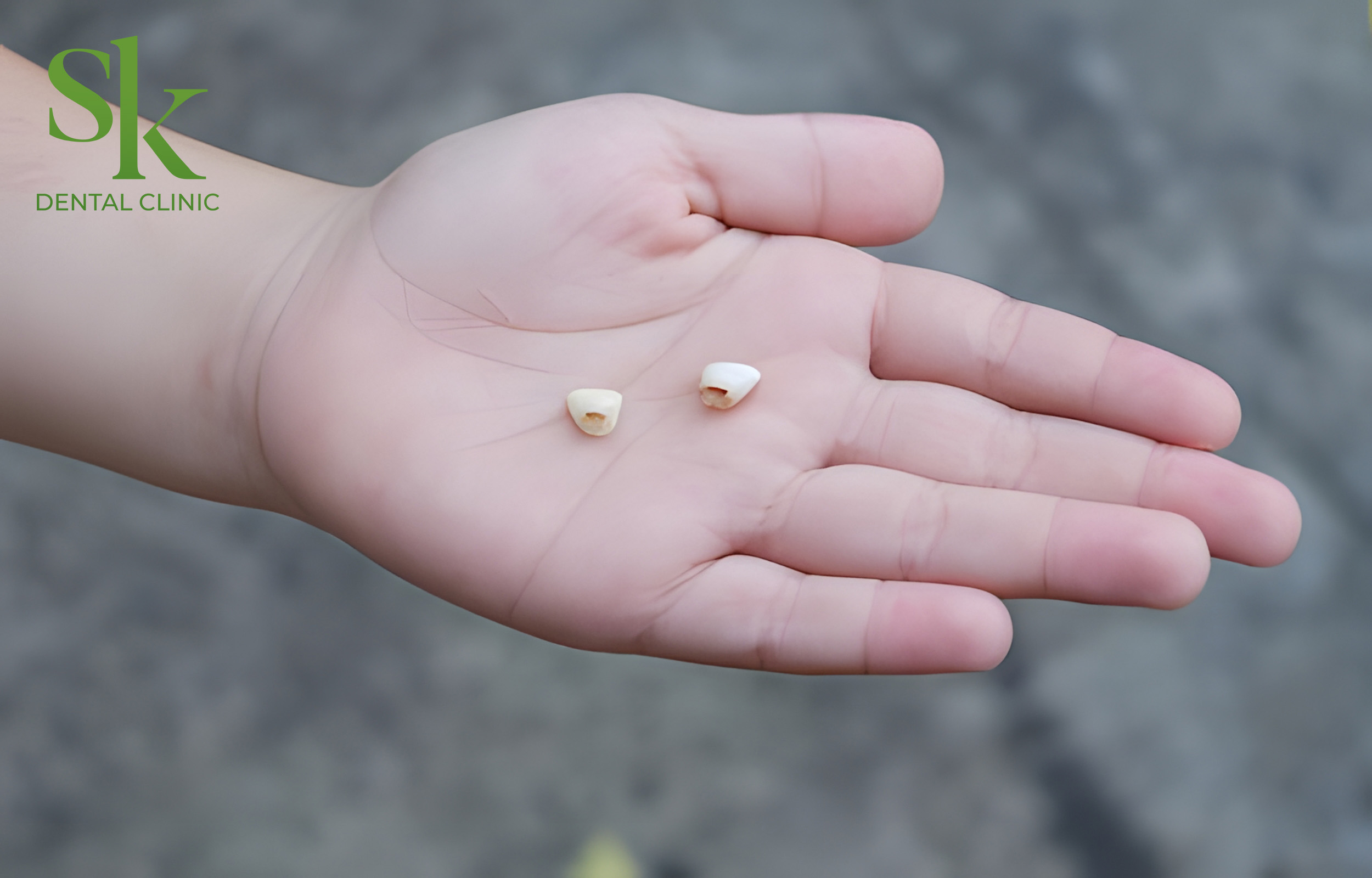 Răng sứ bị rụng