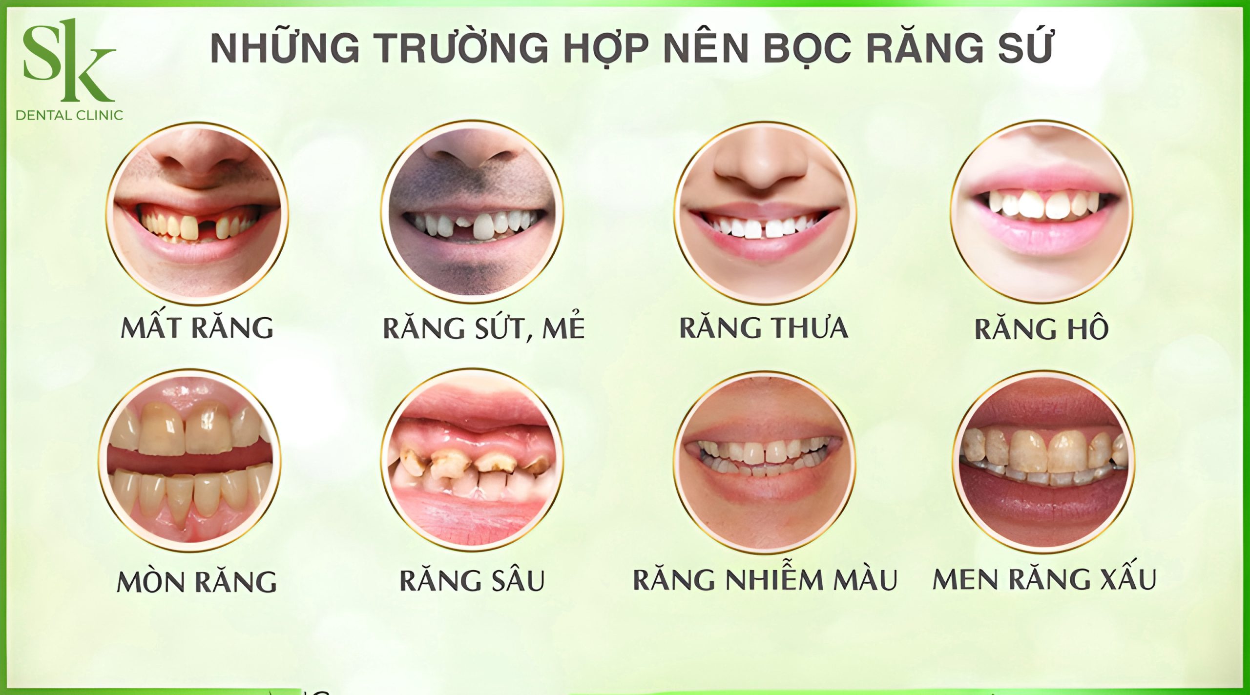 Trường hợp CÓ THỂ bọc răng sứ