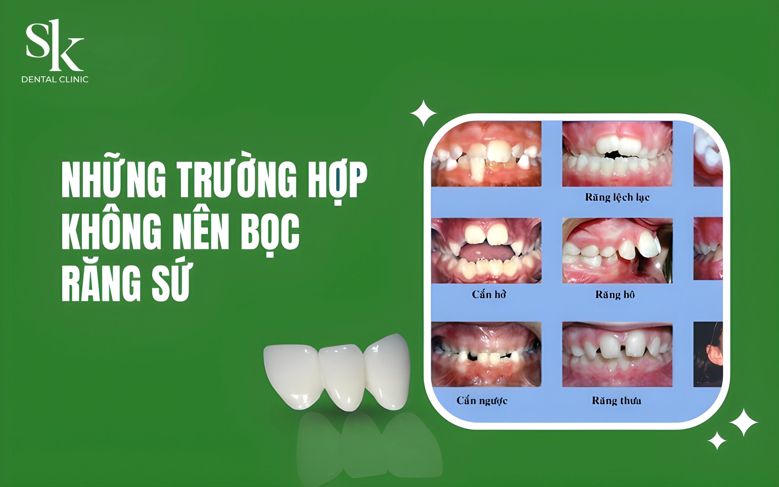 Trường hợp KHÔNG NÊN bọc răng sứ