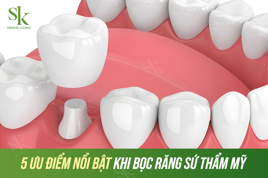 Bọc răng sứ - Giải pháp phục hình răng được ưa chuộng hiện nay