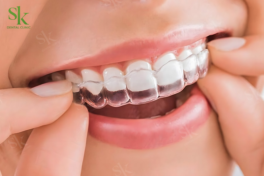 Niềng răng chưa bao giờ là quá muộn