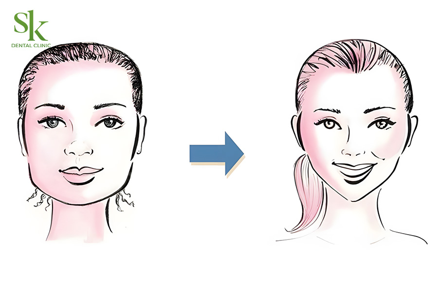 Niềng răng có thể thay đổi khuôn mặt theo hướng tích cực