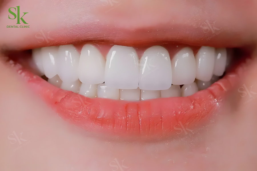 Bọc răng sứ đem lại nhiều lợi ích cho răng