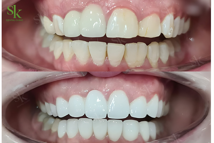 Màu sắc răng tự nhiên có ảnh hưởng đến răng sứ