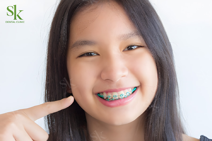 Độ tuổi 12–16 khi răng và xương hàm phát triển thuận lợi nhất cho chỉnh nha