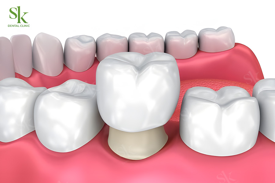 Các tiêu chí cần quan tâm khi bọc răng sứ