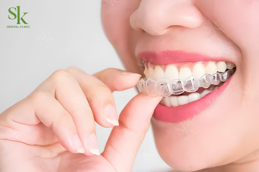 Khuôn mặt có thể thay đổi theo hướng hài hòa và cân đối hơn sau niềng răng. 