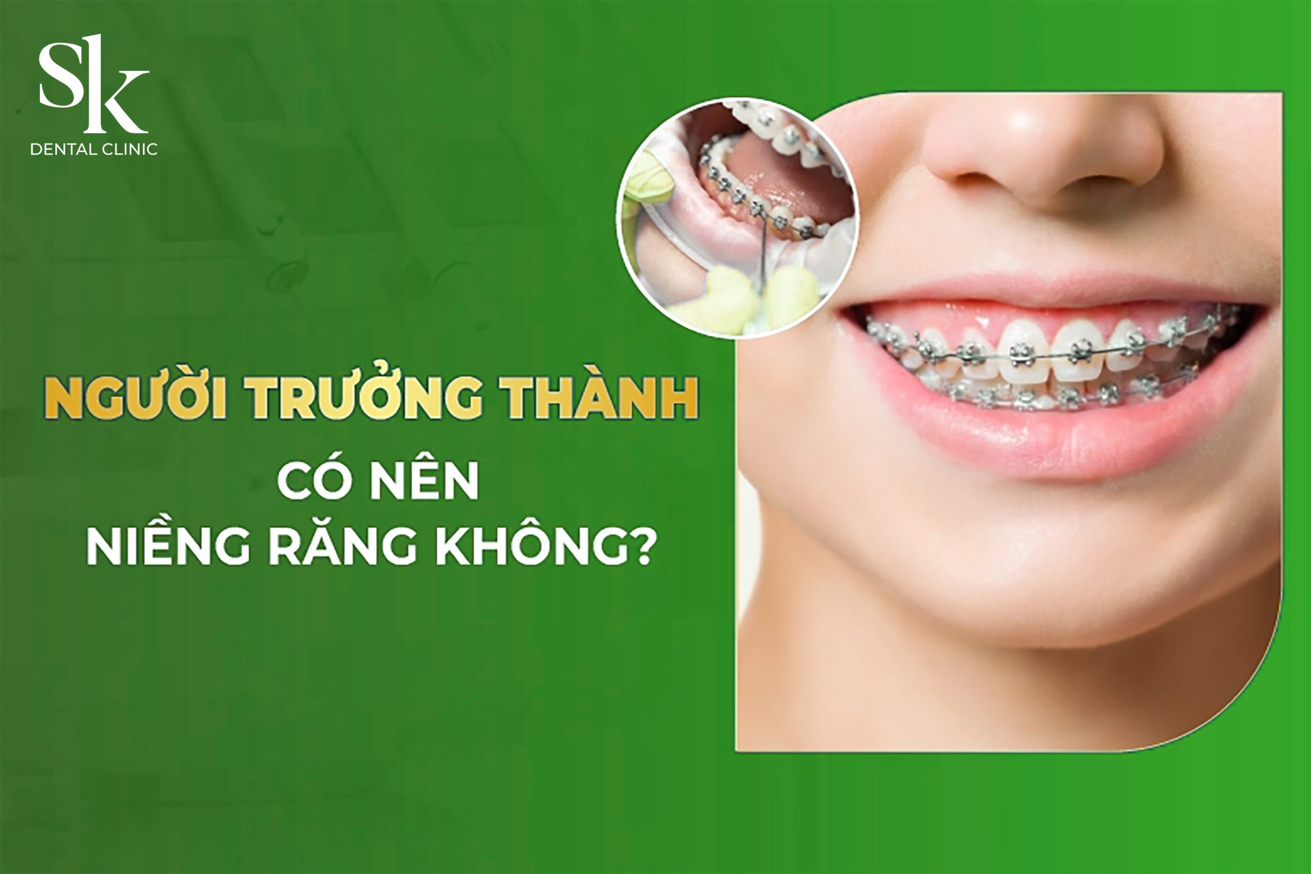 Niềng răng cho người lớn