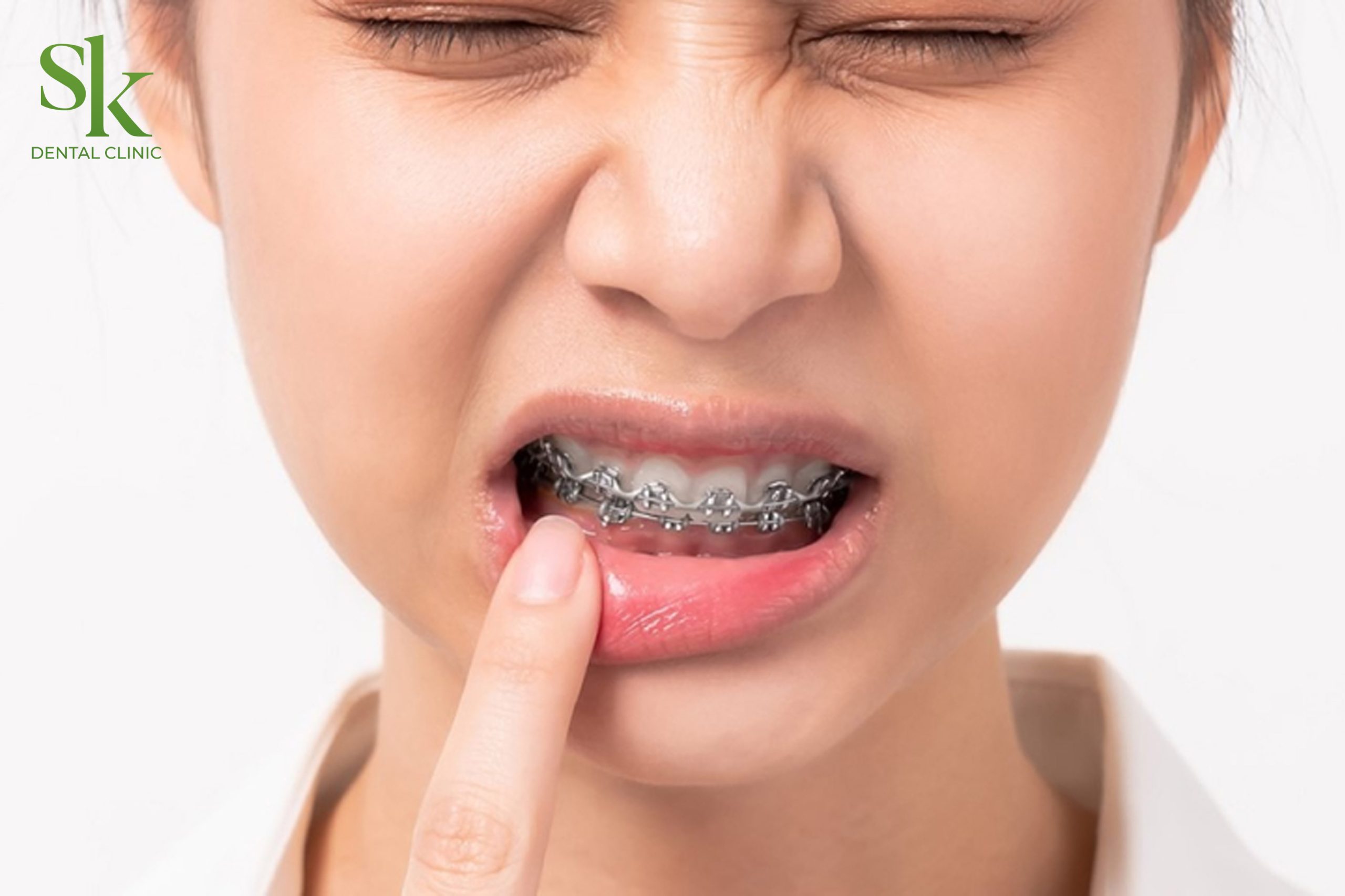 Đau răng khi niềng răng