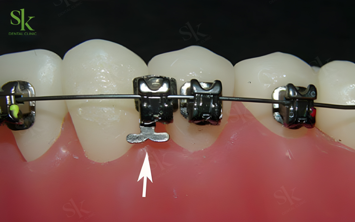 Dây cung lệch mạnh – bung mắc cài