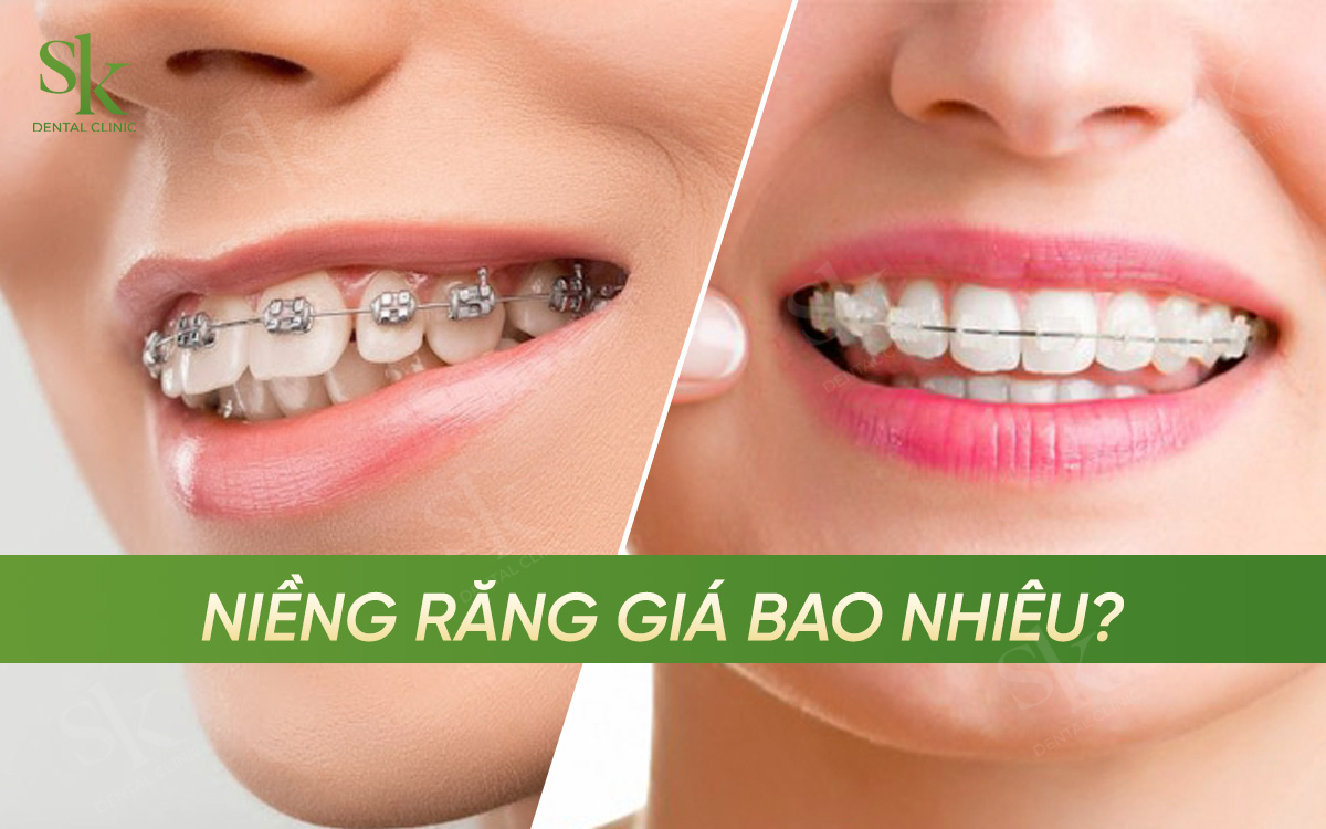 Niềng răng giá bao nhiêu?
