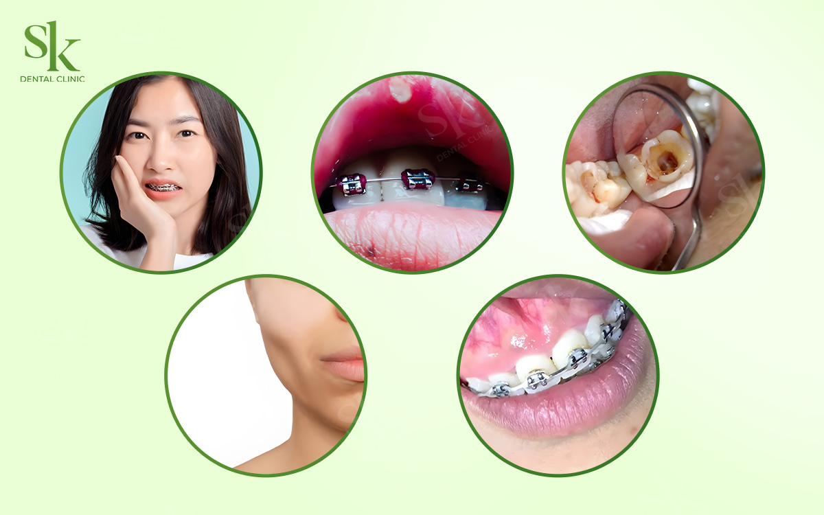 Những ảnh hưởng phổ biến nhất khi niềng răng