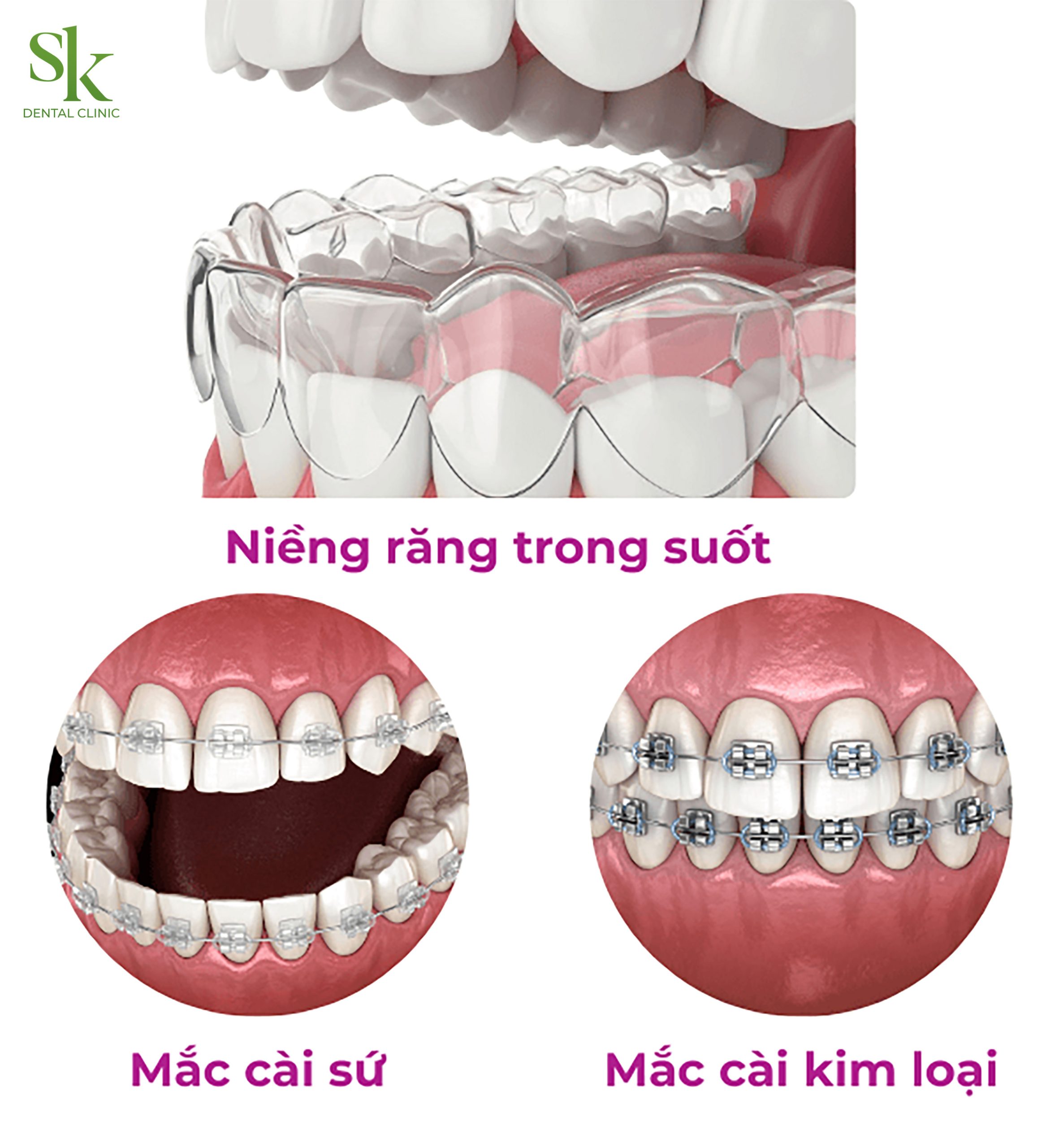 Các phương pháp niềng răng phổ biến hiện nay