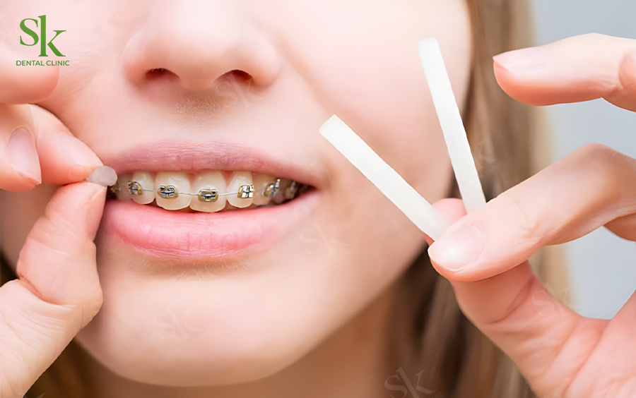 Dùng sáp nha khoa bôi lên mắc cài tránh trầy xước