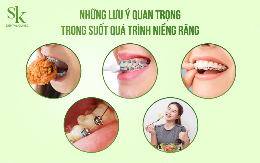 Lưu ý trong quá trình niềng răng