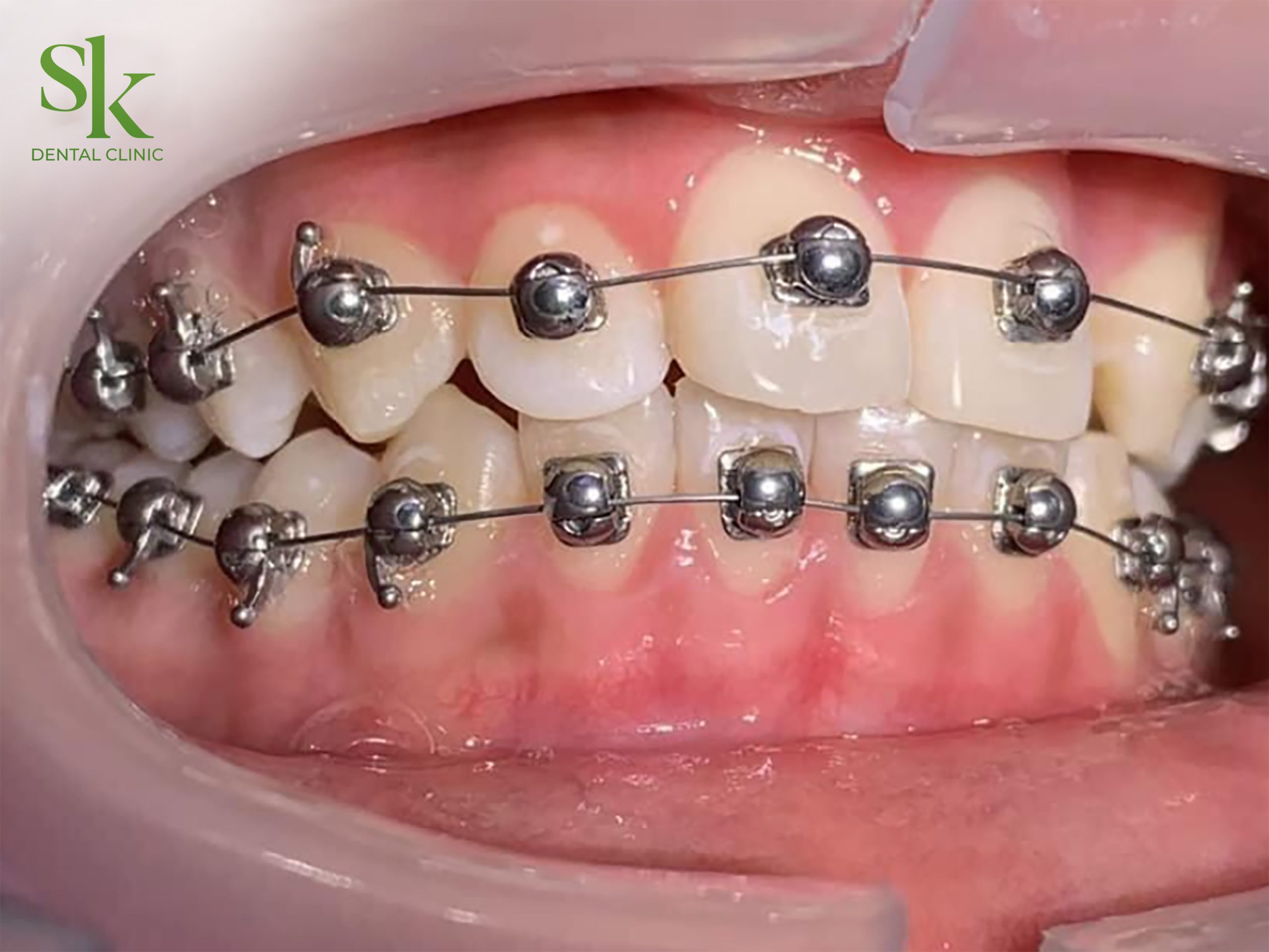 Niềng răng mắc cài cánh cam đem lại nhiều lợi ích tuyệt vời