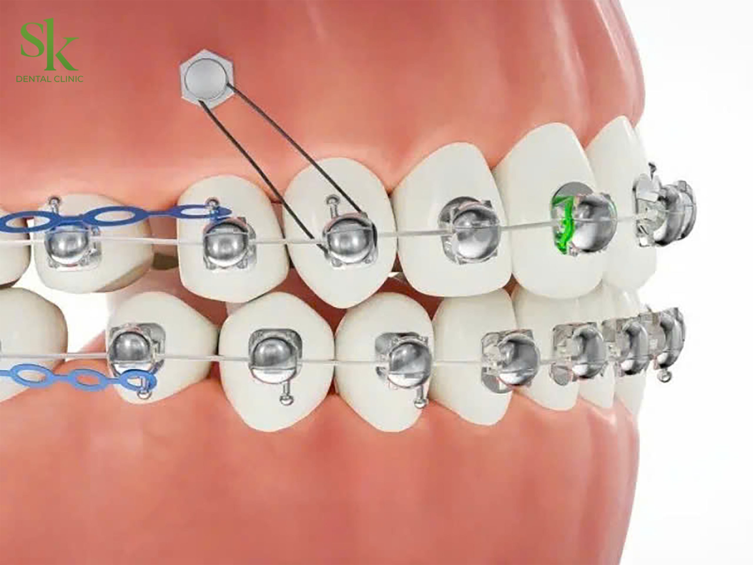 Niềng mắc cài cánh cam phù hợp với đa số các case chỉnh nha từ nhẹ đến phức tạp