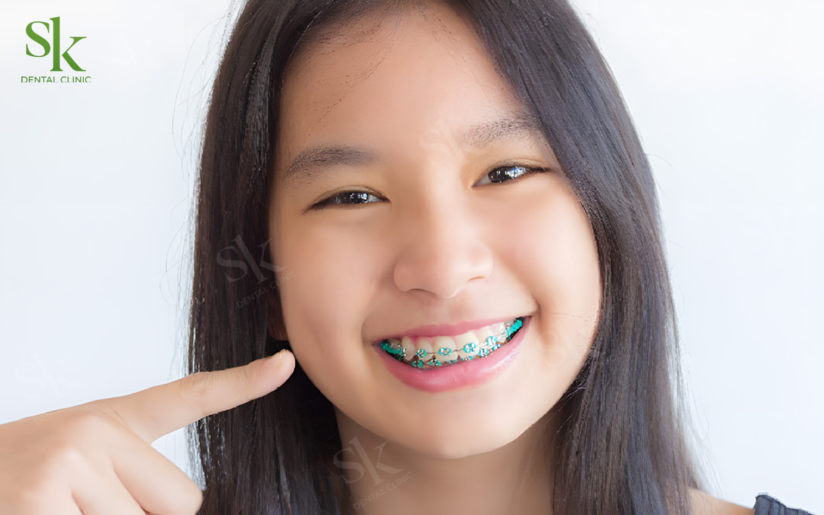 Niềng răng trẻ em