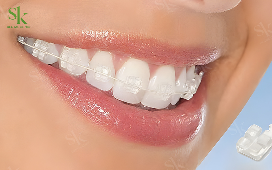 Niềng mắc cài sứ / tự buộc