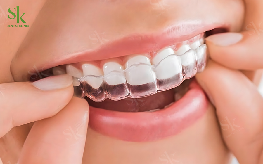 Niềng trong suốt